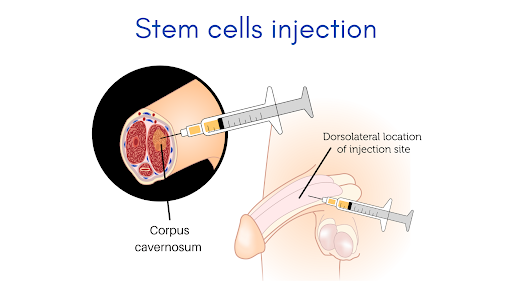 stem cell treatment for erectile dysfunction